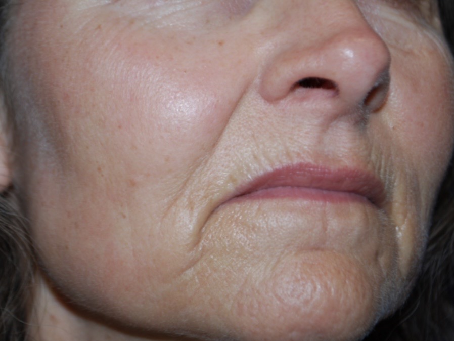 MLP 20 micron en ProFractional Heavy voor en na (1 sessie)