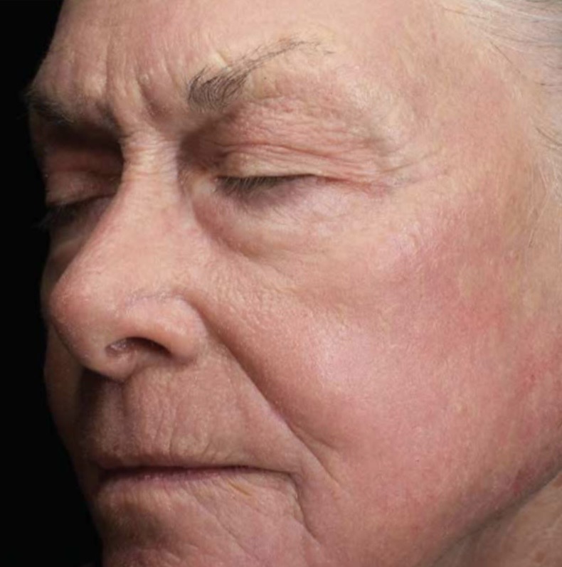 Sciton Resurfacing Contour TRL voor en na (1 sessie)