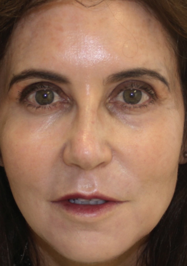Sciton Resurfacing Contour TRL voor en na (1 sessie)