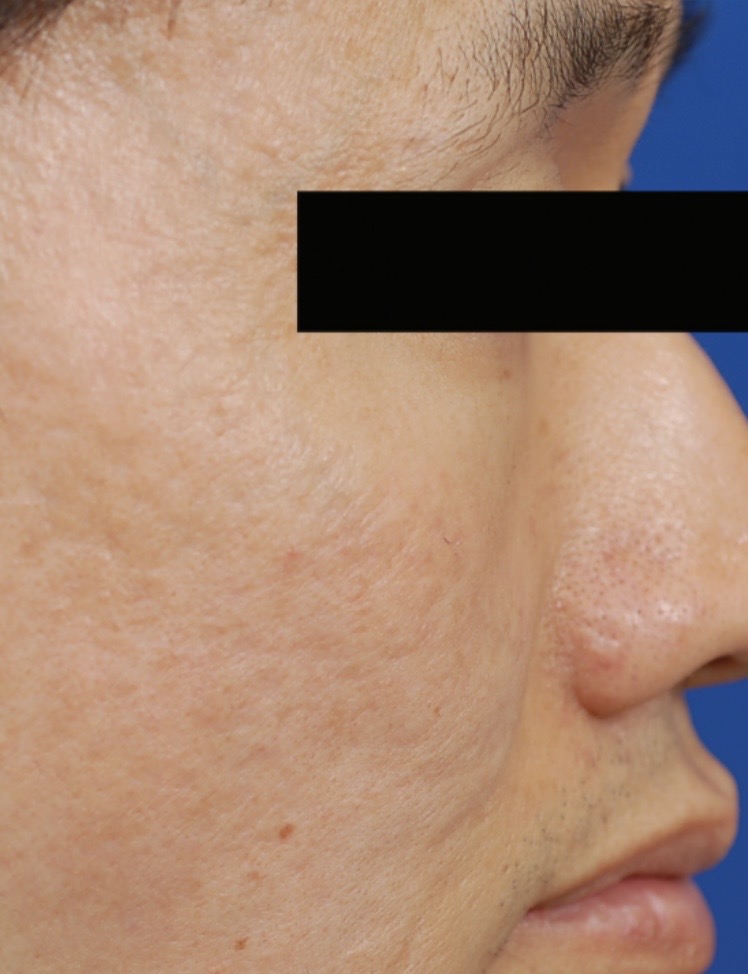 ProFractional Heavy en Contour TRL acnelittekens voor en na (2 sessies)
