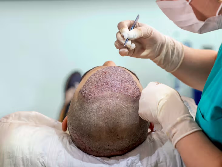 FUE haartransplantatie