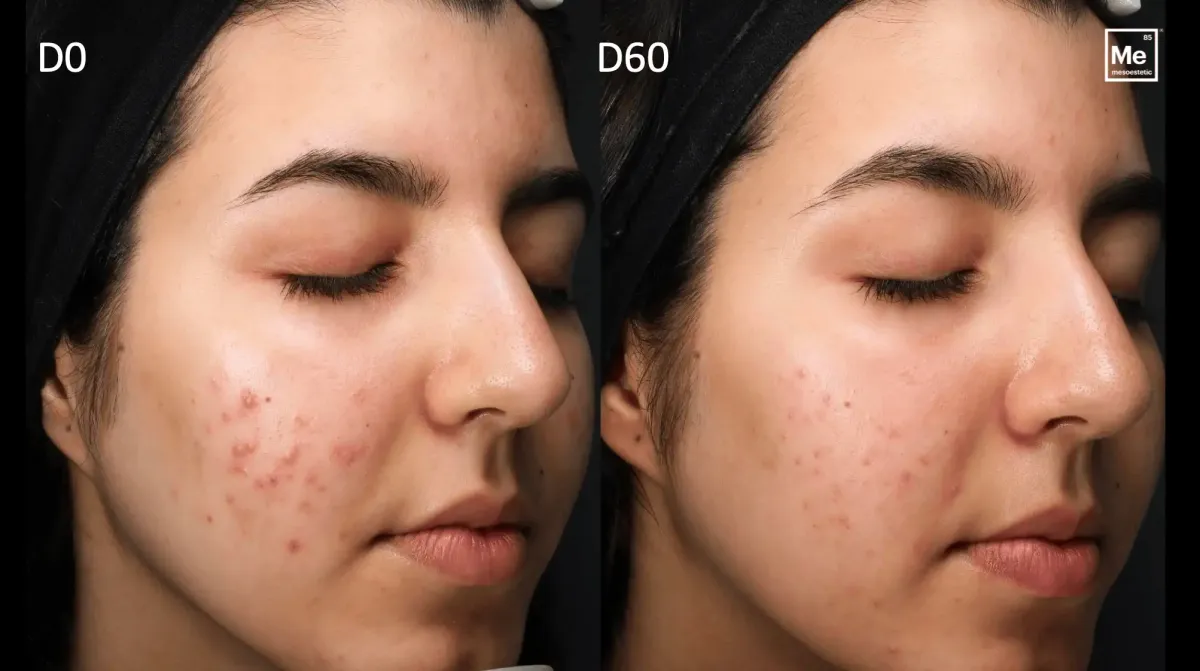Blemiderm Acnépeel